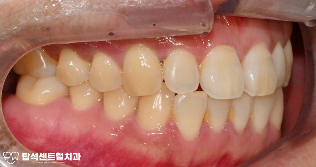 윗니 어금니 끝에서 통증이 느껴질 때
대부분 충치나 잇몸 질환을 의심합니다.

실제로 많은 경우, 치아 자체의 문제로
통증이 발생하는 것이 사실입니다.