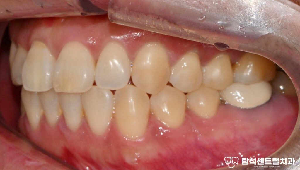 윗니 어금니 끝에서 통증이 느껴질 때
대부분 충치나 잇몸 질환을 의심합니다.

실제로 많은 경우, 치아 자체의 문제로
통증이 발생하는 것이 사실입니다.