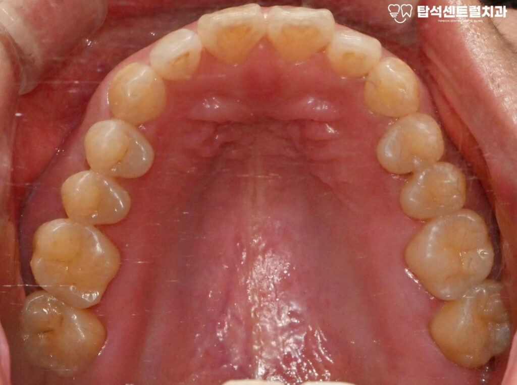 윗니 어금니 끝에서 통증이 느껴질 때
대부분 충치나 잇몸 질환을 의심합니다.

실제로 많은 경우, 치아 자체의 문제로
통증이 발생하는 것이 사실입니다.