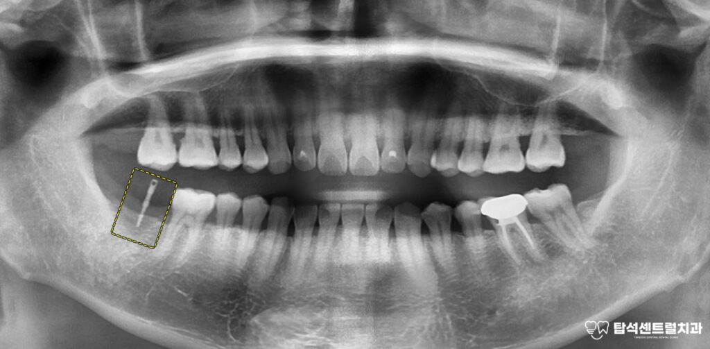 잇몸뼈의 상태를 확인한 모습입니다.

잇몸 뼈가 남아 있는 양에 따라,
뼈이식의 필요 유무가 정해집니다.