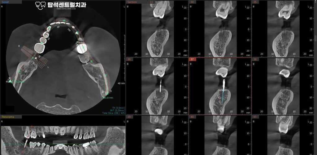 잇몸뼈의 상태를 확인한 모습입니다.

잇몸 뼈가 남아 있는 양에 따라,
뼈이식의 필요 유무가 정해집니다.
