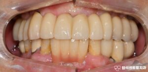 Read more about the article 송산역 치과 임플란트 주위염 증상 방치하여 통증, 골소실 일어난 경우 어떻게 치료해야 될까