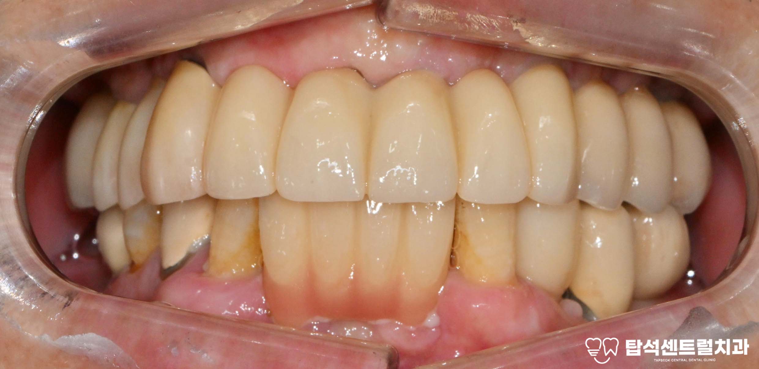 You are currently viewing 송산역 치과 임플란트 주위염 증상 방치하여 통증, 골소실 일어난 경우 어떻게 치료해야 될까