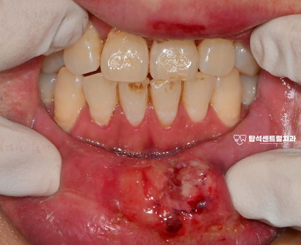 안녕하세요

용현동 치과 입니다.

빙판길 낙상, 구강 부상의 원인이 될 수 있습니다

겨울철에는 도로와 인도가
단단하게 얼어붙는 경우가 많습니다.

이런 빙판길에서 미끄러지면
손을 짚기도 전에 얼굴부터
바닥에 부딪히는 사고가 발생합니다.

특히 전치부는 충격에 취약한
위치에 있어서 넘어질 때
직접적인 타격을 받기 쉽습니다.

아침 출근길이나 등굣길에
빙판에 미끄러져 입 안쪽까지
다치는 상황이 생길 수 있는데요.

추운 날씨에 몸이 경직되어 있으면
넘어질 때 순간적인 대처가
어려워지기도 합니다.

이때 앞니 흔들림이 있다면,
최대한 자연치아를 보존하기 위해
신속하게 적절한 진료를 받는 것이
무엇보다 중요합니다.