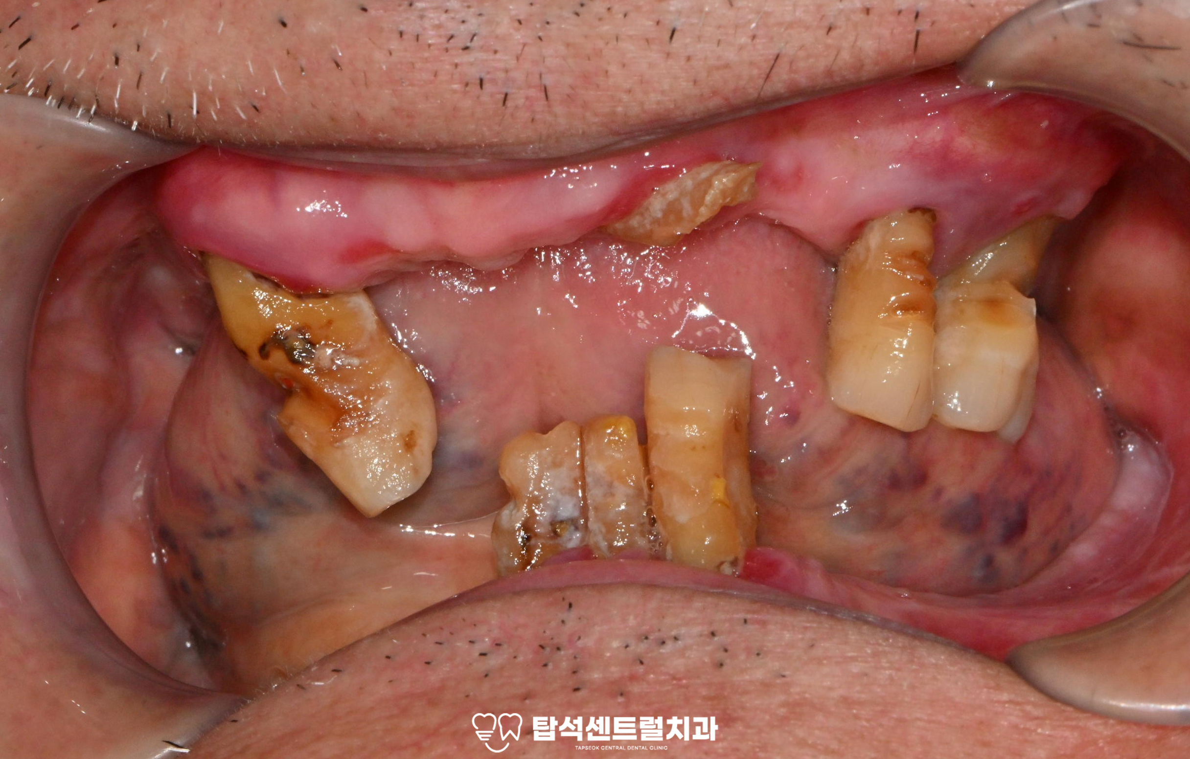 You are currently viewing 민락동 치과 기능을 잃은 치아 발치 후 전체 임플란트 식립 feat. IBS 가이드핀