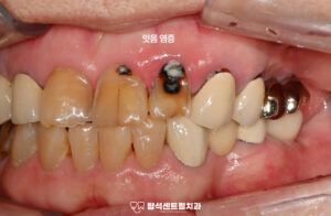 Read more about the article 의정부 치과 전치부 심한 치근 우식으로 본드필레진 수복